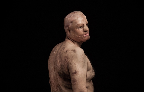 The courageous survivors of acid throwing attacks in Iran